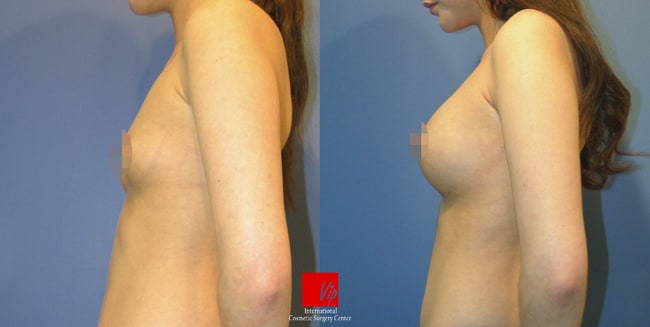 	Breast Surgery, Body Contouring	 - Breast augmentation with round type implant
