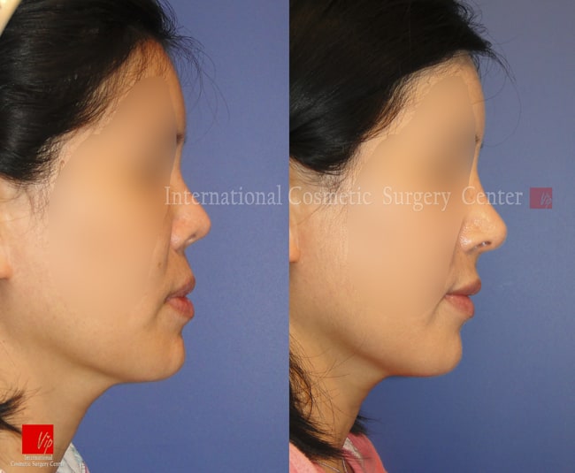 	Harmony-Rhinoplasty, Protruded Mouth Correction Rhinoplasty, Rib cartilage Rhinoplasty, Contracted Nose, Revision Rhinoplasty	 - Harmony rhinoplasty - 100% Rib cartilage