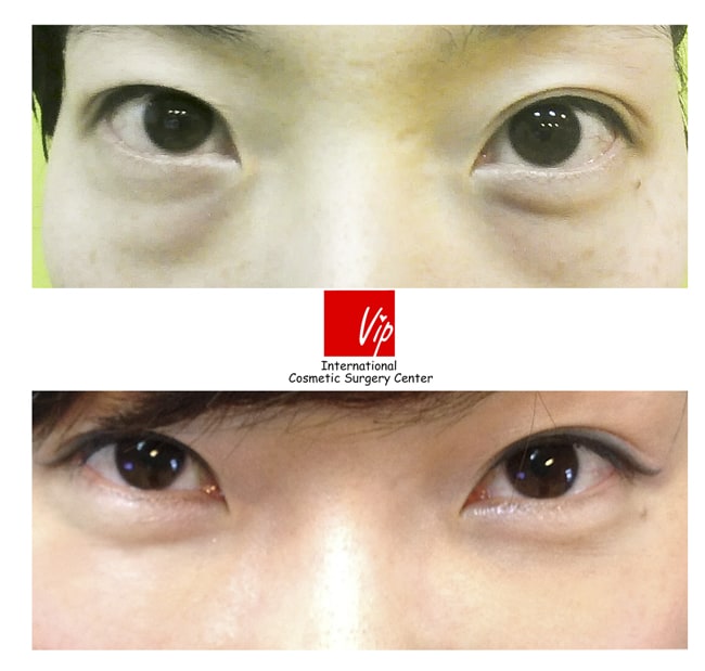 Eye Surgery - Lower Eyelid Fat Relocation