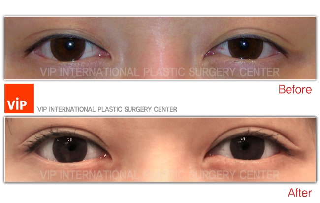	Eye Surgery, Double Fold	 - Non-incision double eyelid
