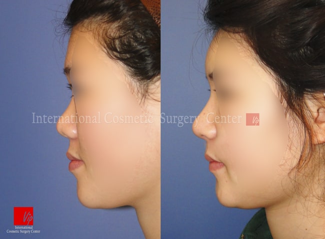 	Nose Surgery, Harmony-Rhinoplasty, Rib cartilage Rhinoplasty	 - Harmony line rhinoplasty