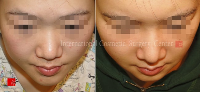 	Nose Surgery, Harmony-Rhinoplasty, Rib cartilage Rhinoplasty	 - Harmony line rhinoplasty
