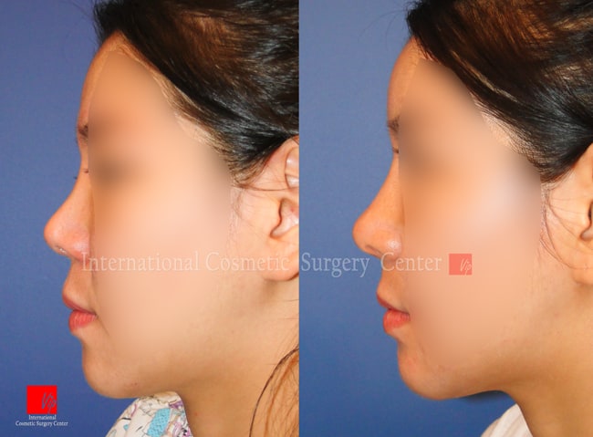	Nose Surgery, Rib cartilage Rhinoplasty, Revision Rhinoplasty	 - Revision of Rib cartilage rhinoplasty
