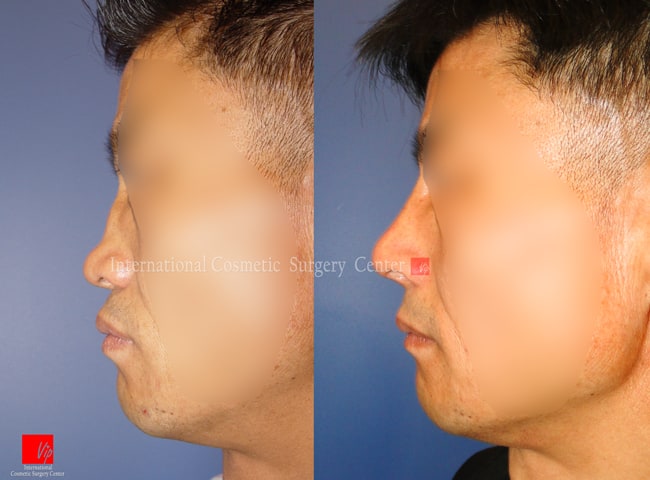 Nonsurgical Rhinoplasty  San Francisco  Dr ChiuCollins