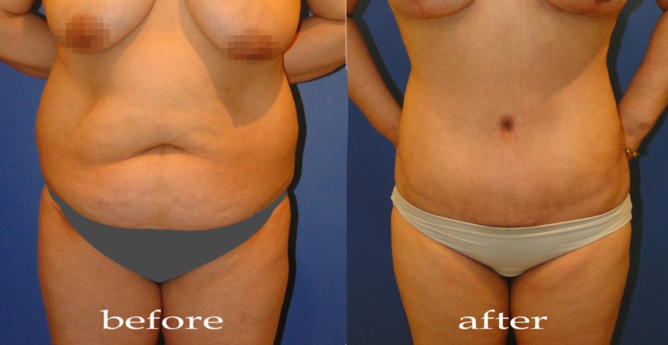Body Contouring - Liposuction