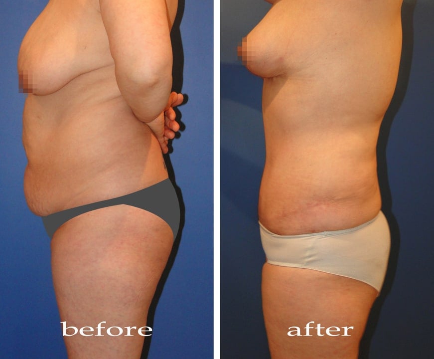 Body Contouring - Liposuction