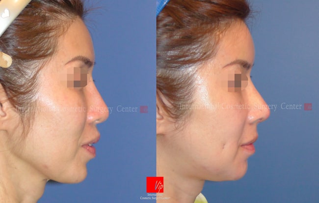 	Nose Surgery, Rib cartilage Rhinoplasty, Revision Rhinoplasty	 - Revisional rhinoplasty using Rib carilage