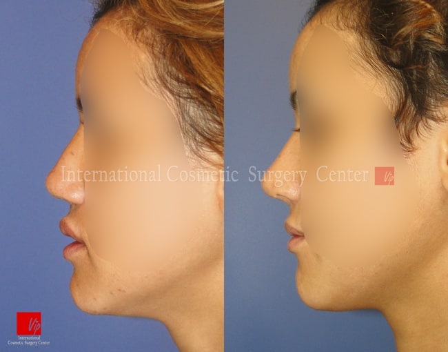 	Nose Surgery, Harmony-Rhinoplasty, Rib cartilage Rhinoplasty, Contracted Nose, Revision Rhinoplasty	 - 2nd Rib cartilage Op.- Nostril obstruction  by car accident