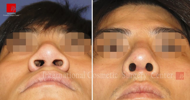 	Harmony-Rhinoplasty, Protruded Mouth Correction Rhinoplasty, Rib cartilage Rhinoplasty	 - Male rhinoplasty