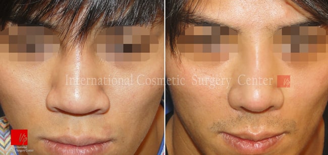 	Harmony-Rhinoplasty, Protruded Mouth Correction Rhinoplasty, Rib cartilage Rhinoplasty	 - Male rhinoplasty