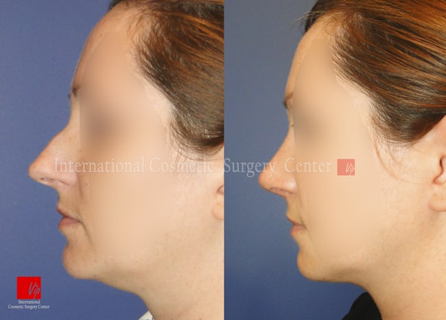 	Nose Surgery, Harmony-Rhinoplasty, Each Cases Nose	 - Septal deviation - Caucasian