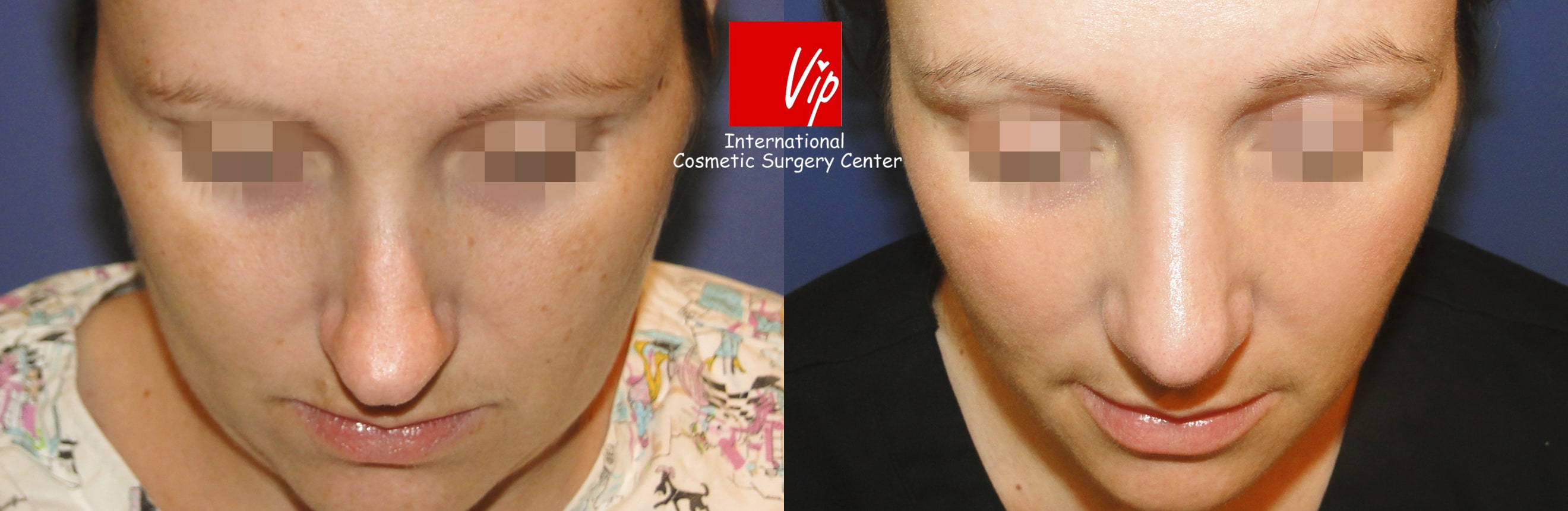 	Nose Surgery, Harmony-Rhinoplasty, Each Cases Nose	 - Septal deviation - Caucasian