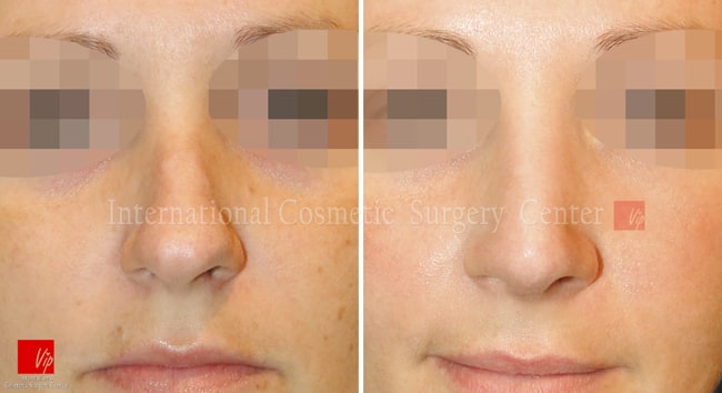 	Nose Surgery, Harmony-Rhinoplasty, Each Cases Nose	 - Septal deviation - Caucasian