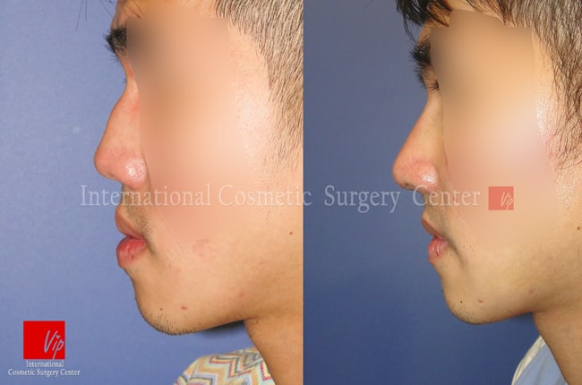 	Harmony-Rhinoplasty, Protruded Mouth Correction Rhinoplasty, Rib cartilage Rhinoplasty	 - Low and deviated male nose