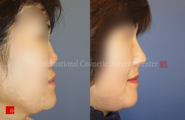 	Nose Surgery, Harmony-Rhinoplasty, Rib cartilage Rhinoplasty, Contracted Nose, Revision Rhinoplasty	 - Collapsed nose due to side effects from foreign implant - Revision with  Rib cartilage