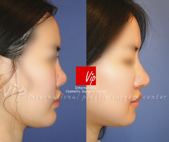	Harmony-Rhinoplasty, Protruded Mouth Correction Rhinoplasty, Contracted Nose	 - Ribcartilage rhinoplasty - Improvement of mouth protrusion