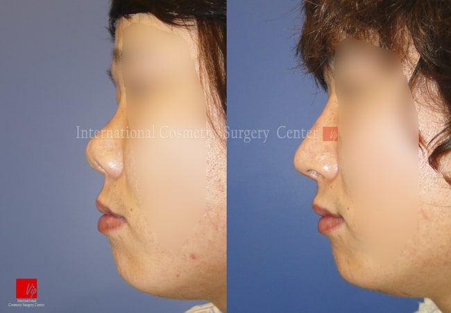 	Rib cartilage Rhinoplasty, Revision Rhinoplasty, Each Cases Nose, Septal Deviation	 - Male Septal deviation