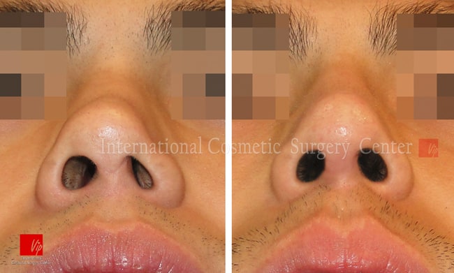 	Rib cartilage Rhinoplasty, Contracted Nose, Revision Rhinoplasty	 - Nasal septal deviation Revision case