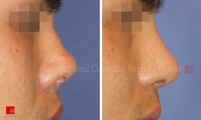 	Rib cartilage Rhinoplasty, Contracted Nose, Revision Rhinoplasty	 - Nasal septal deviation Revision case