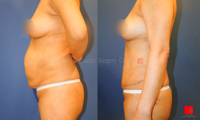 	Breast Surgery, Body Contouring	 - Abdominal surgery + Liposuction