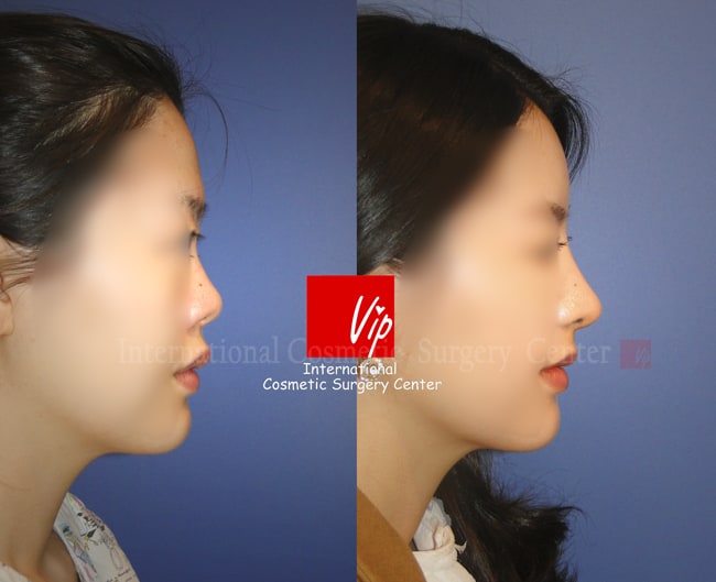 	Harmony-Rhinoplasty, Protruded Mouth Correction Rhinoplasty, Rib cartilage Rhinoplasty	 - Ribcartilage rhinoplasty