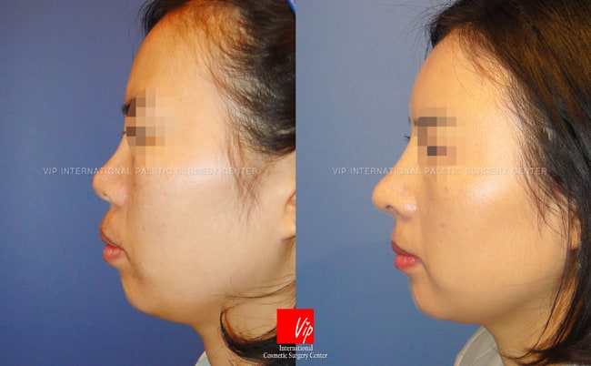 	Nose Surgery, Rib cartilage Rhinoplasty, Revision Rhinoplasty	 - upturned nose caused by silicon implant - Revised rib carilage rhinoplasty