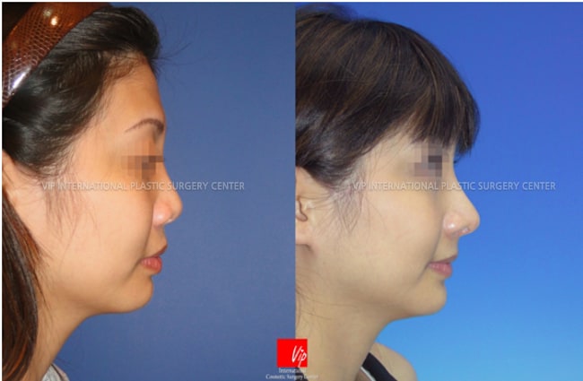 	Nose Surgery, Harmony-Rhinoplasty, Rib cartilage Rhinoplasty	 - Asian nose with bulbous tip and wide alar - changed as higher and slimmer nose using Rib cartilage
