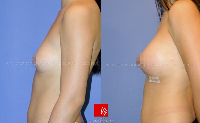 	Breast Surgery, Body Contouring	 - Seven days after tear drop breast surgery