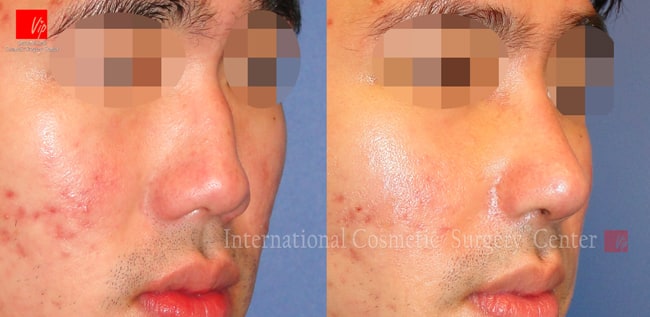 	Harmony-Rhinoplasty, Protruded Mouth Correction Rhinoplasty, Rib cartilage Rhinoplasty	 - Low and deviated male nose