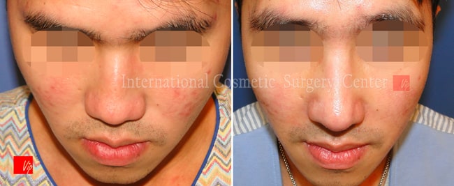 	Harmony-Rhinoplasty, Protruded Mouth Correction Rhinoplasty, Rib cartilage Rhinoplasty	 - Low and deviated male nose