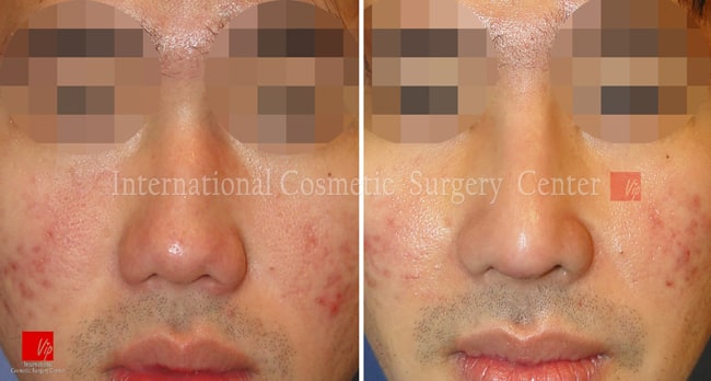 	Harmony-Rhinoplasty, Protruded Mouth Correction Rhinoplasty, Rib cartilage Rhinoplasty	 - Low and deviated male nose