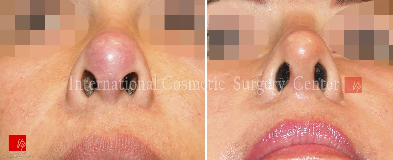 	Rib cartilage Rhinoplasty, Revision Rhinoplasty, Each Cases Nose	 - Infection by illegal procedure