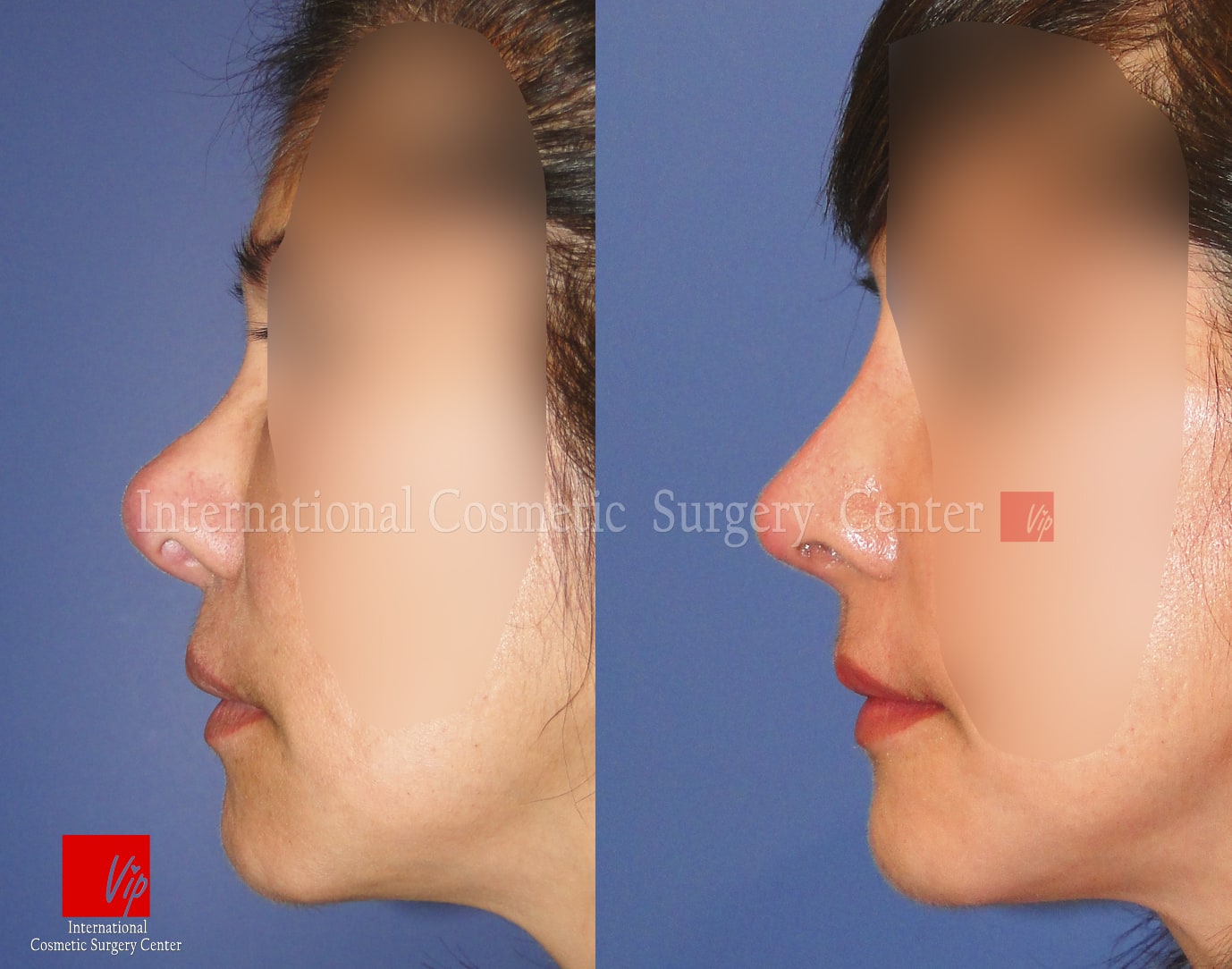 	Rib cartilage Rhinoplasty, Revision Rhinoplasty, Each Cases Nose	 - Infection by illegal procedure