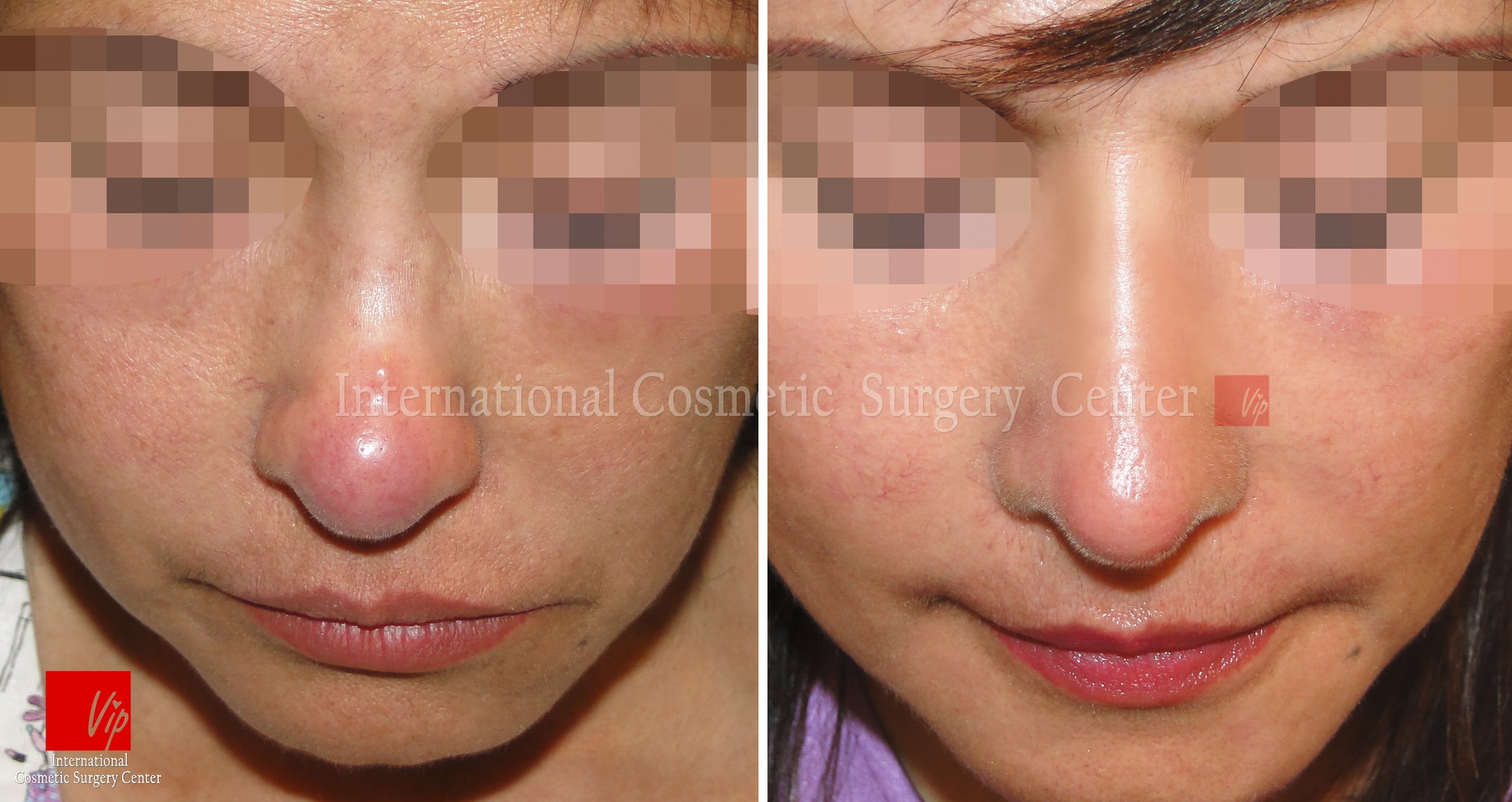 	Rib cartilage Rhinoplasty, Revision Rhinoplasty, Each Cases Nose	 - Infection by illegal procedure