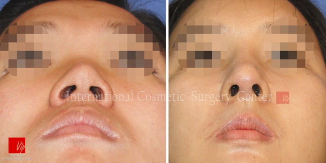 	Harmony-Rhinoplasty, Protruded Mouth Correction Rhinoplasty, Rib cartilage Rhinoplasty	 - Flat nose correction