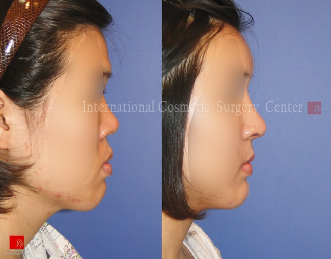 	Harmony-Rhinoplasty, Protruded Mouth Correction Rhinoplasty, Rib cartilage Rhinoplasty	 - Flat nose correction
