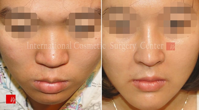 	Harmony-Rhinoplasty, Protruded Mouth Correction Rhinoplasty, Rib cartilage Rhinoplasty	 - Flat nose correction