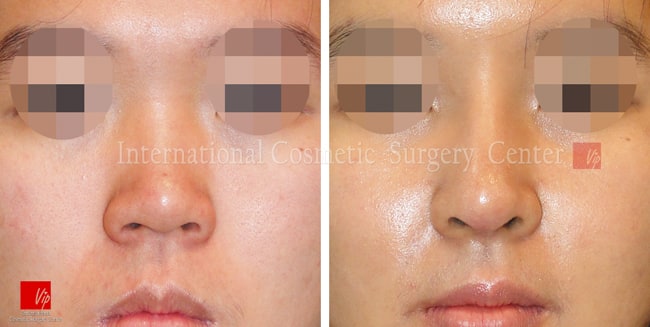 	Harmony-Rhinoplasty, Protruded Mouth Correction Rhinoplasty, Rib cartilage Rhinoplasty	 - Flat nose correction