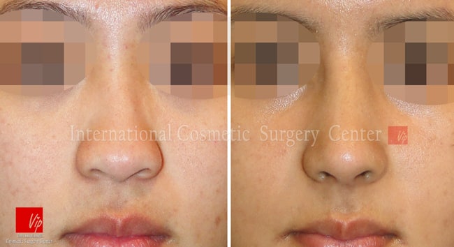 	Nose Surgery, Rib cartilage Rhinoplasty, Fat graft	 - Autologous Rhinoplasty and Fat graft