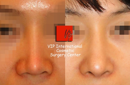 Facial Bone Surgery - VIP High technique rhinoplasty