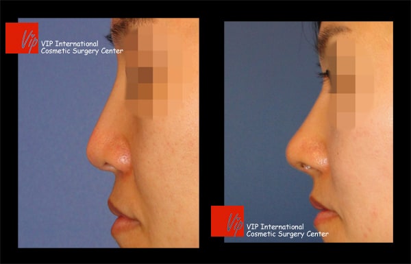 	Nose Surgery, Rib cartilage Rhinoplasty, Each Cases Nose	 - Revision of silicone showing nose - Rib cartilage rhinoplasty