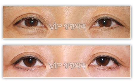 Eye Surgery - Lower blepharoplasty