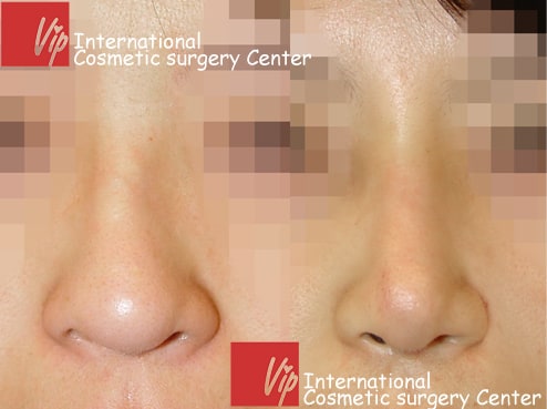 	Nose Surgery, Rib cartilage Rhinoplasty, Revision Rhinoplasty	 - Deviated nose correction