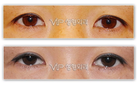 Eye Surgery - Upper blepharoplasty