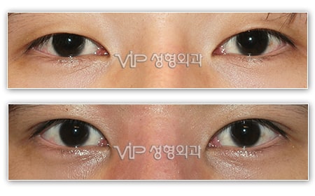 Eye Surgery - Double eyelid