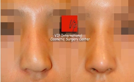 Nose Surgery, Facial Bone Surgery - Humped nose correction (protruded mouth improvement as well)- Rib cartilage rhinoplasty