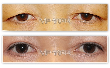 	Eye Surgery, Lower Blepharoplasty	 - Upper blepharoplasty