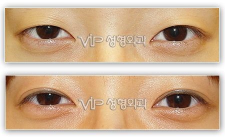 	Eye Surgery, Double Fold	 - Double eyelid