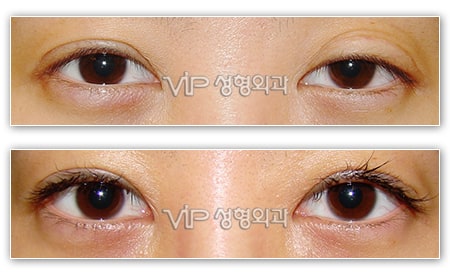 Eye Surgery - Revision of Incision method