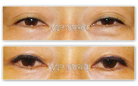 Eye Surgery - Upper & Lower blepharoplasty
